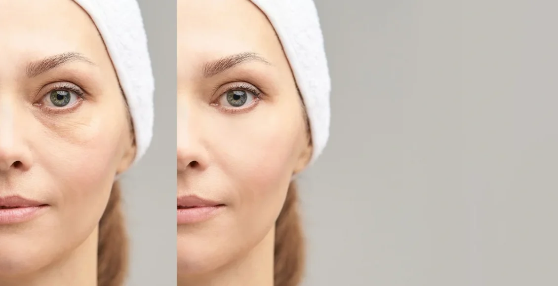 Ομορφιά:-12-λύσεις-για-τις-σακούλες-κάτω-από-τα-μάτια…(6:20-–-Α’-πρωϊνή-Ζώνη-6:00-6:30)