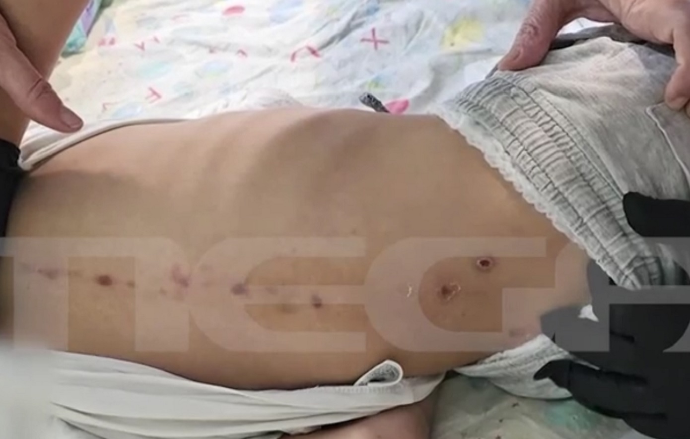 «Θρίλερ»-με-7χρονο-στο-Καραμανδάνειο:-Τα-σημάδια-στην-πλάτη-του-που-κινητοποίησαν-τους-γιατρούς-–-Τι-λέει-ο-πατέρας-του