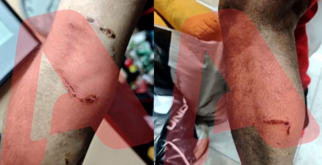 Ομόνοια:-Έδωσε-εντολή-στο-πίτμπουλ-του-να-επιτεθεί-σε-30χρονο-για-να-τον-ληστέψει-–-Σοκάρει-η-μαρτυρία-του-θύματος