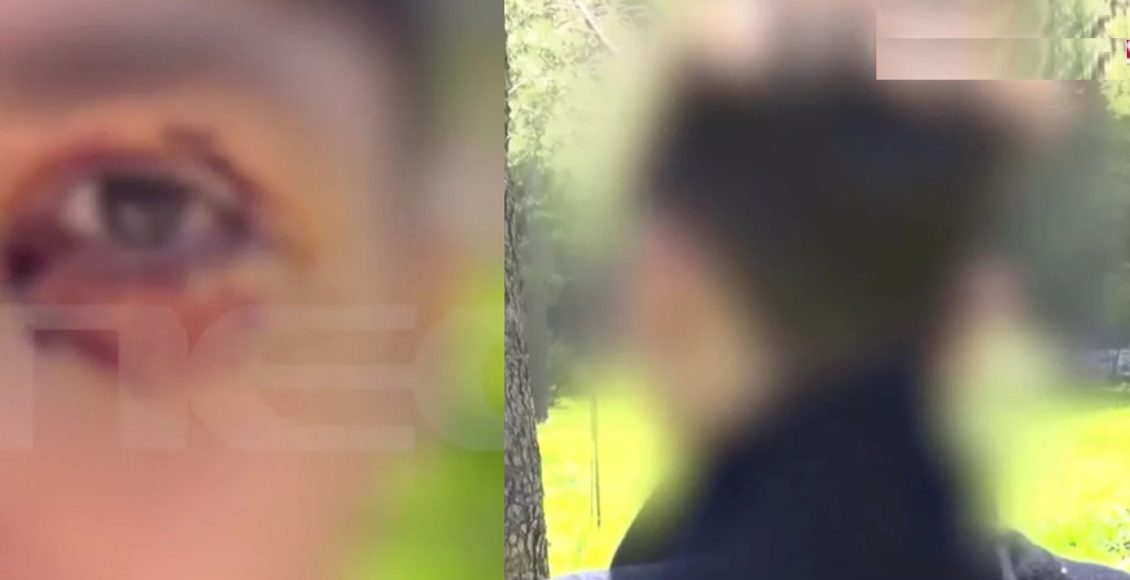 Άγρια-επίθεση-από-ανήλικους-σε-16χρονο-στα-Ιωάννινα-–-Παραλίγο-να-χάσει-το-μάτι-του,-τον-χτύπησαν-με-σιδερογροθιά